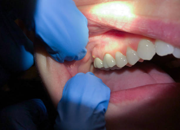 Best Emergency Denture Repair in Proctor, VT
